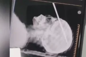 una mujer le clavó un hierro en la cabeza a su concuñada