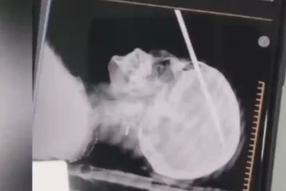 una mujer le clavó un hierro en la cabeza a su concuñada