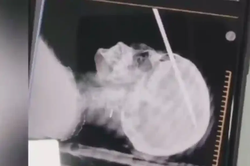 una mujer le clavó un hierro en la cabeza a su concuñada